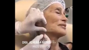 Hilos tensores faciales - Dra. Adriana Ratto