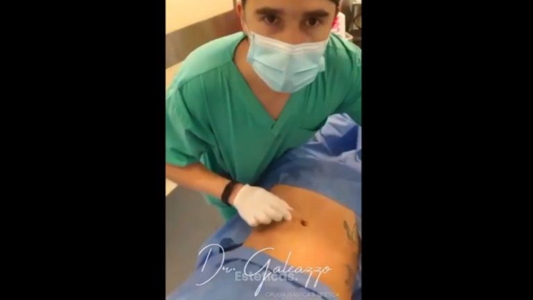 Liposucción con Renuvion - Dr. Damián Galeazzo