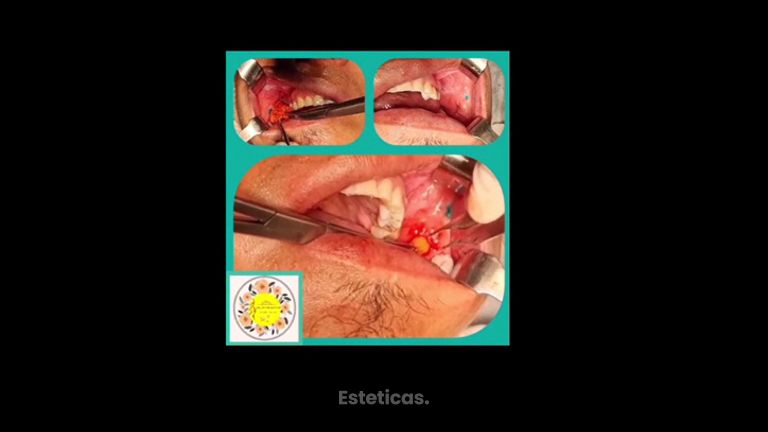 Bichectomia - Dr. Javier Nicolía - Centro Médico Palmares