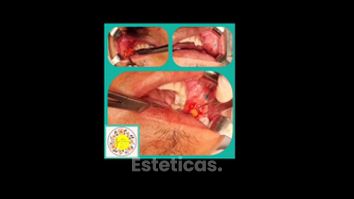 Bichectomia - Dr. Javier Nicolía - Centro Médico Palmares