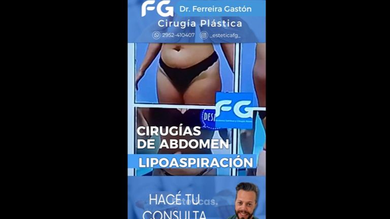 Abdominoplastia - Dr. Gastón Eduardo Ferreira