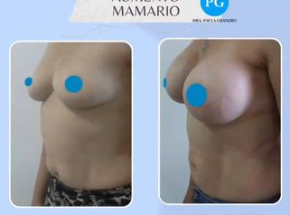 Aumento Mamas - Dra. Paula Granero