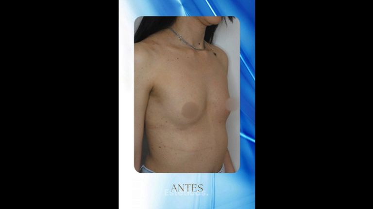 Aumento mamas - Dr. Rodolfo Villavicencio