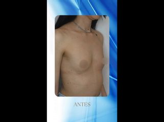 Aumento mamas - Dr. Rodolfo Villavicencio