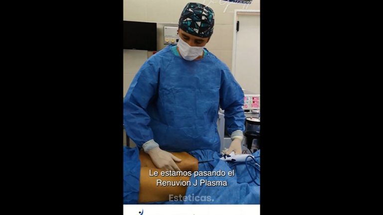 Renuvion J Plasma - Dr. Damián Galeazzo y Equipo