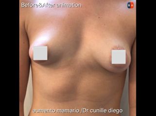 Aumento mamas - Dr. Diego Cunille