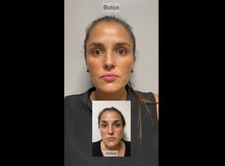 Botox - Dr. Santiago Rosales Castiglione