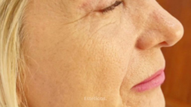 Blefaroplastia - Dra. Laura Marin