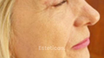 Blefaroplastia - Dra. Laura Marin