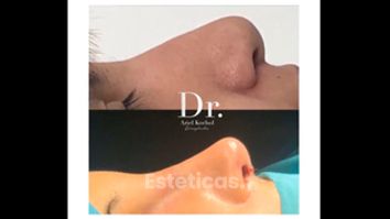 Rinoplastia - Dr. Ariel Kochol