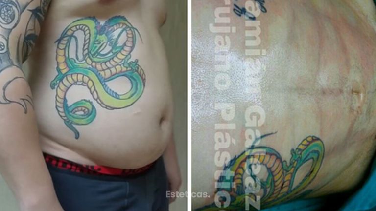 Liposucción con marcación abdominal