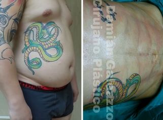 Liposucción con marcación abdominal