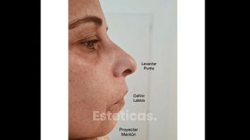 Rellenos faciales - Dr Luis Corrales