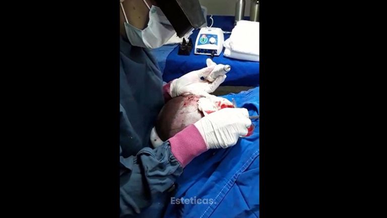 Implante capilar - Dr. Jose Luis Moretti