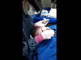 Implante capilar - Dr. Jose Luis Moretti
