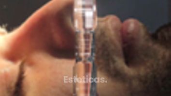 Rinoplastía ultrasónica - Dra. Natalia Solimano