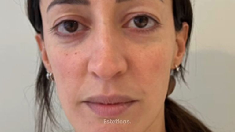 Blefaroplastia - Dra. María Victoria Rodríguez