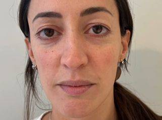 Blefaroplastia - Dra. María Victoria Rodríguez