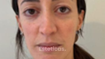 Blefaroplastia - Dra. María Victoria Rodríguez