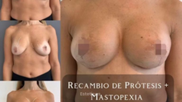Mastopexia con recambio de protesis - Dr. Alejandro J Merello Abente