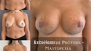 Mastopexia con recambio de protesis - Dr. Alejandro J Merello Abente