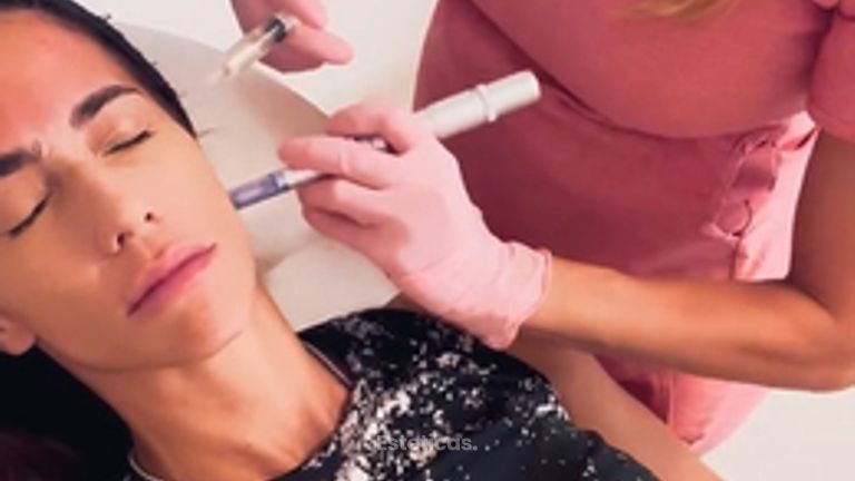 Dermapen con Acido Hialuriónico -Dra. Jimena D. Frasso
