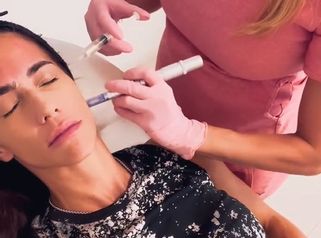Dermapen con Acido Hialuriónico -Dra. Jimena D. Frasso