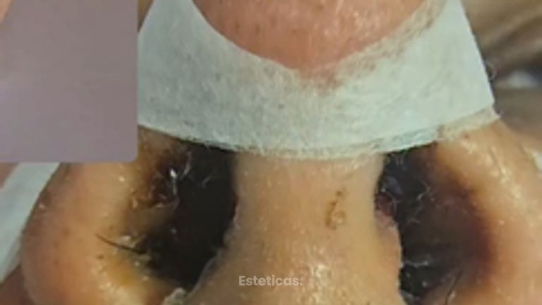 Rinoplastia sin corte en la columela (sin cicatriz) - Dr. Damián Galeazzo y Equipo