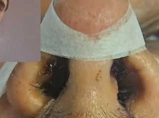 Rinoplastia sin corte en la columela (sin cicatriz) - Dr. Damián Galeazzo y Equipo