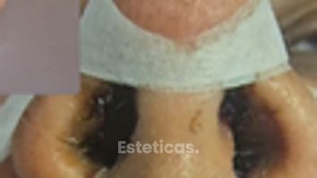 Rinoplastia sin corte en la columela (sin cicatriz) - Dr. Damián Galeazzo y Equipo