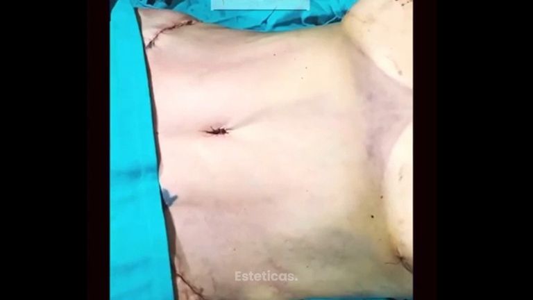 Abdominoplastia - Dr. Fabian Vargas Carrasco