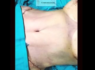 Abdominoplastia - Dr. Fabian Vargas Carrasco