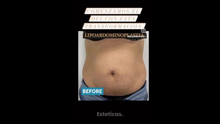 Lipoabdominoplastia - Dr. Juan Martín Saá