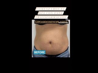 Lipoabdominoplastia - Dr. Juan Martín Saá