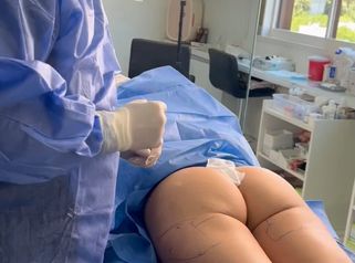 Endolift Laser no quirúrgico - Escobar Aesthetic Clinic