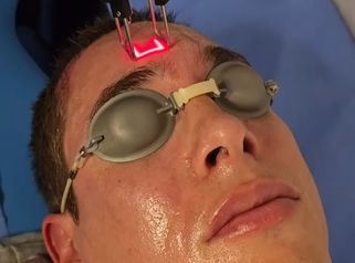 Láser CO2 facial para hombres - Dr. Damián Galeazzo y Equipo