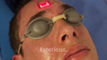 Láser CO2 facial para hombres - Dr. Damián Galeazzo y Equipo