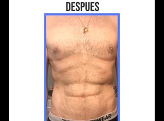 Lipoescultura
