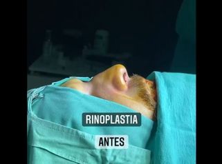 Rinoplastia - Dr. Emmanuel Manavela Chiapero