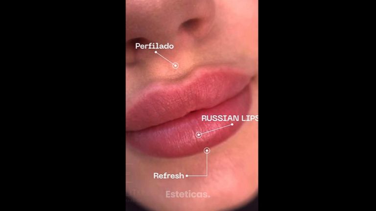 Rellenos de labios - Dra. Anahi Versace