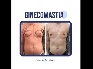 Ginecomastia