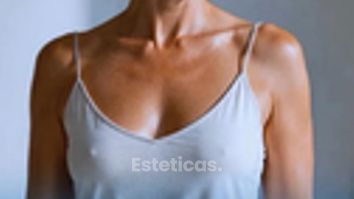No toda Mastopexia lleva implantes - Dr. Maximiliano Gil Miranda