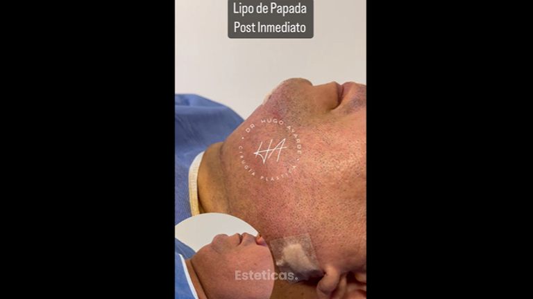 Liposucción - Dr. Hugo Ayarde
