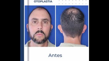 Otoplastia - Dr. Ricardo C. Bevilacqua