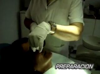 Elimina el frenillo labial
