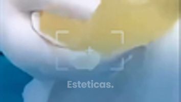 Implante mamario roto - Dr. Maximiliano Gil Miranda