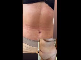 Abdominoplastia - Dr. Diego Mayer