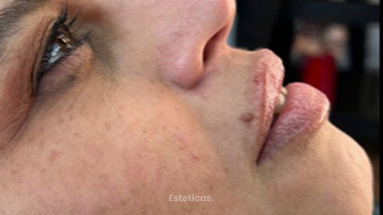 Rinomodelación + Aumento de labios - Estetica Cirene