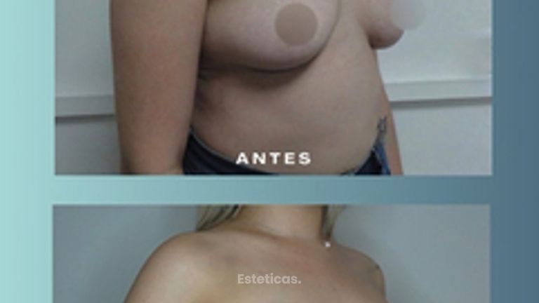 Aumento mamas - Dr. Rodolfo Villavicencio