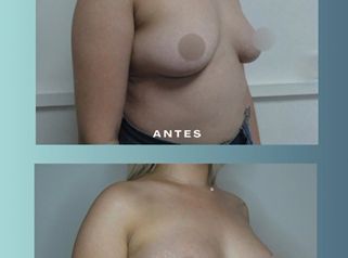 Aumento mamas - Dr. Rodolfo Villavicencio